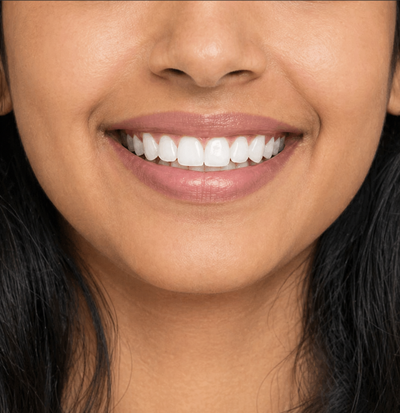 After professional teeth whitening — bright white smile