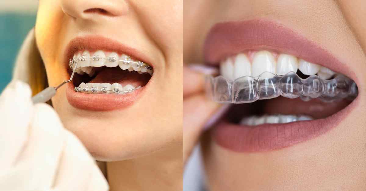 Aligners & Braces in Shela Ahmedabad
