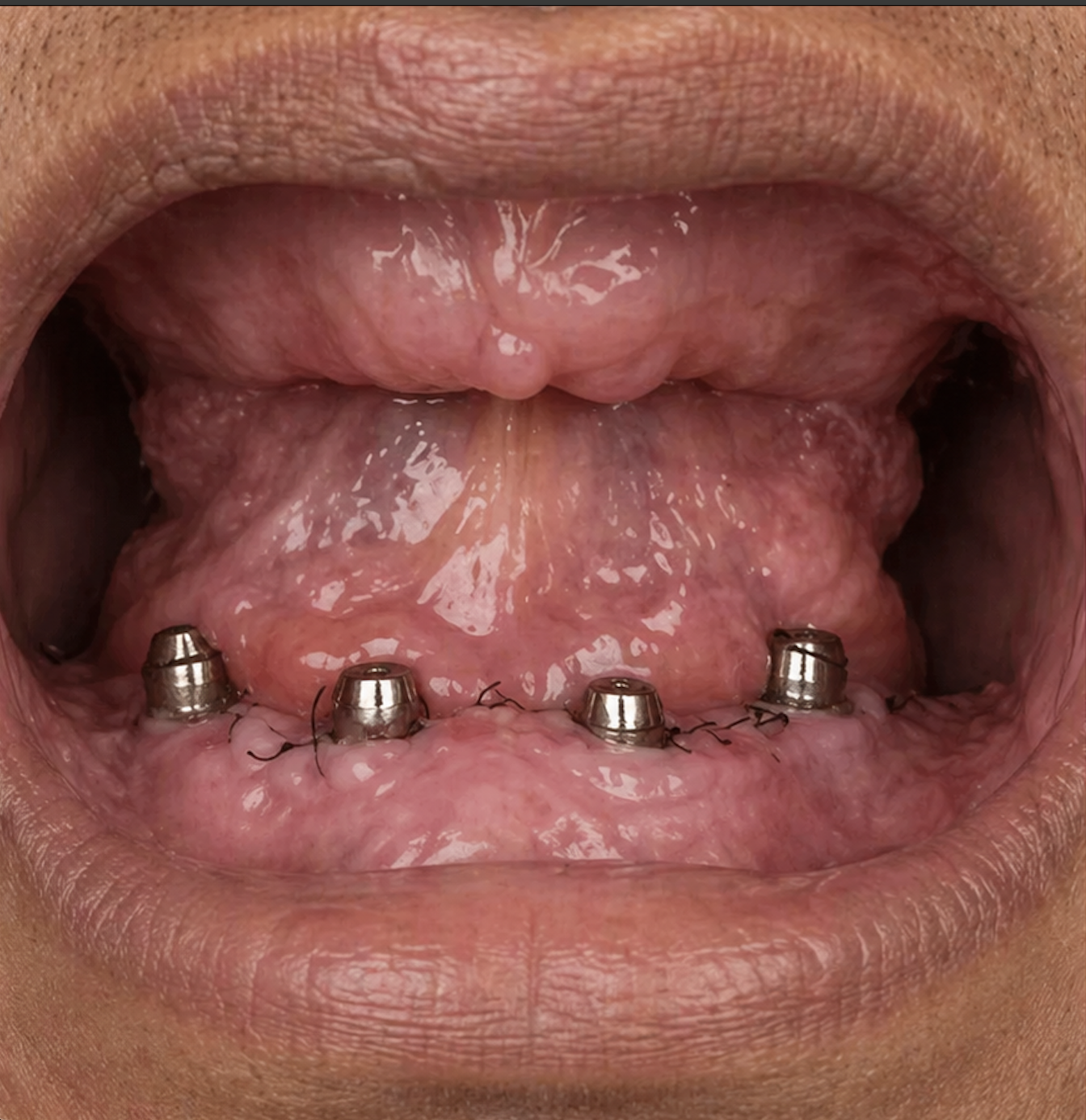 Before dental implant — missing tooth