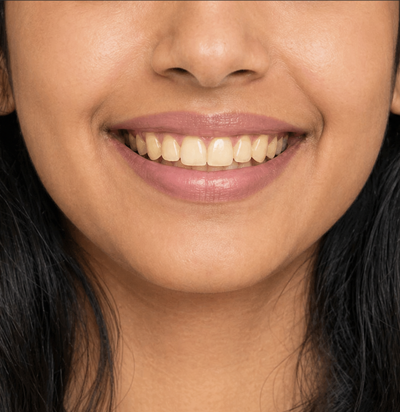 Before teeth whitening treatment