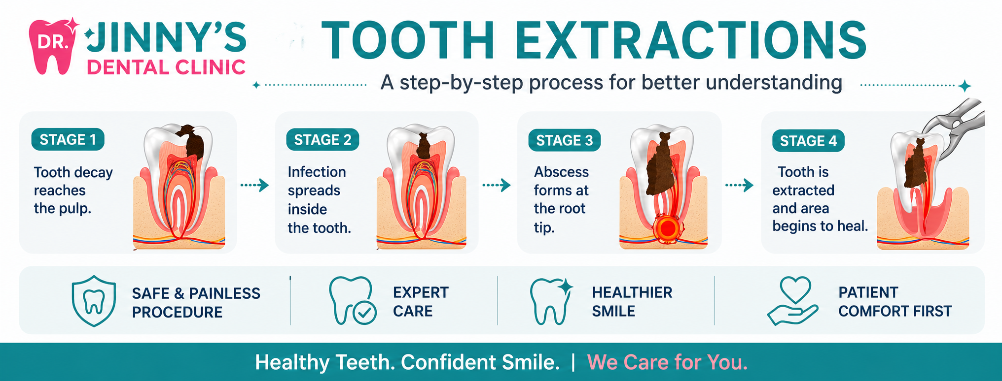 Tooth Extraction in Shela Ahmedabad