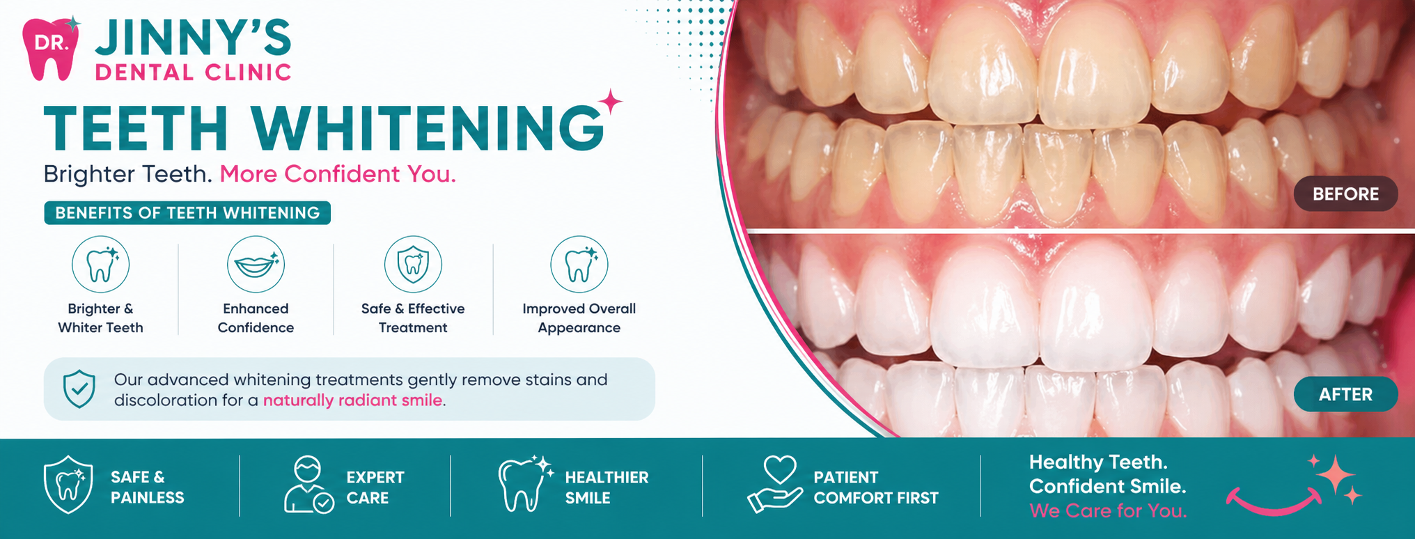 Professional Teeth Whitening in Shela, Ahmedabad at Dr. Jinny's Dental Clinic Shela