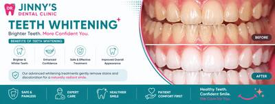 Teeth Whitening in Shela Ahmedabad