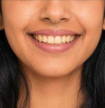 Before teeth whitening treatment