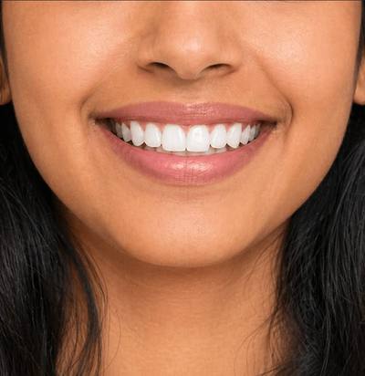 After professional teeth whitening — bright white smile