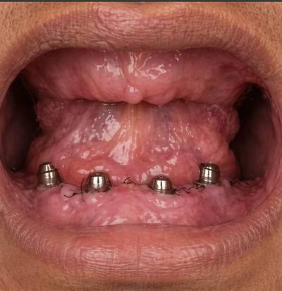 Before dental implant — missing tooth